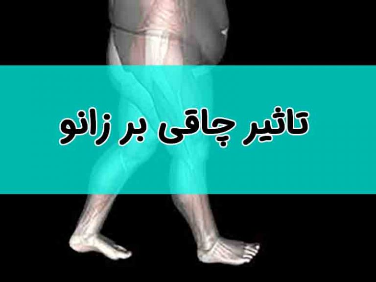 تاثیر چاقی بر زانو