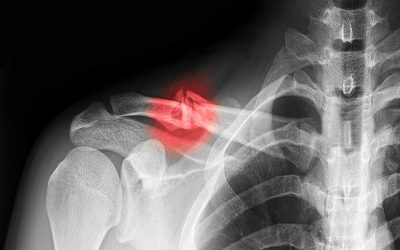 جوش نخوردن شکستگی استخوان – علل و روش های درمان