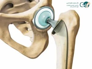 بهترین جراح تعویض مفصل لگن در شیراز