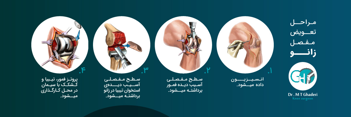 مراحل تعویض مفصل زانو